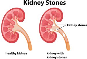 Kidney Stones Treatment Without Surgery